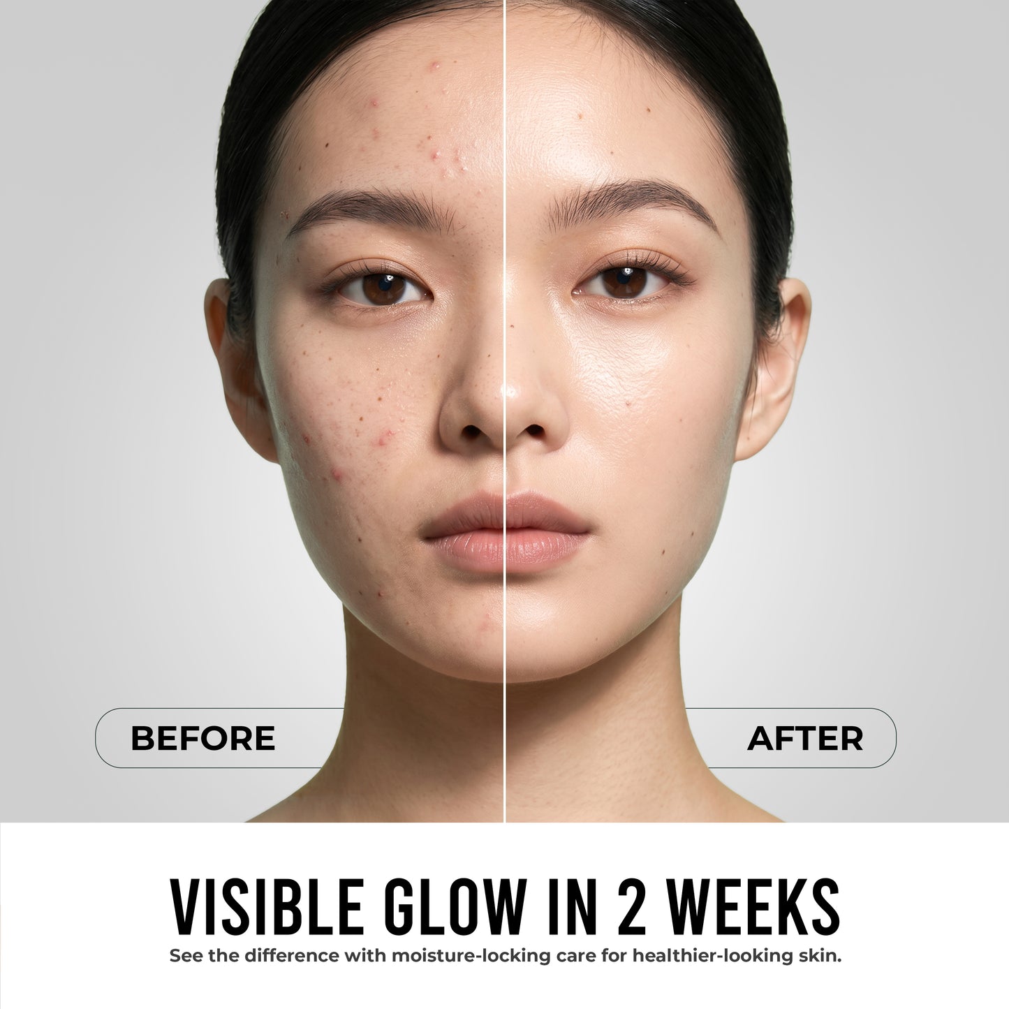 Anti Acne Face Serum